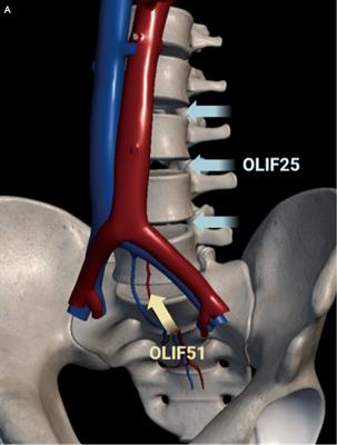 Application of the oblique lateral interbody fusion technique in salvage surgery: technical note and case series